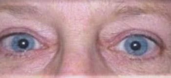 Brow Lift case #10952