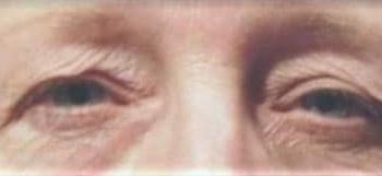 Brow Lift case #10952