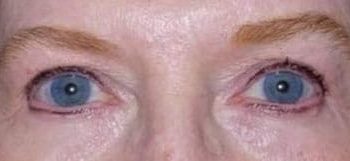 Brow Lift case #10949