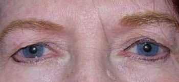 Brow Lift case #10949