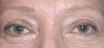 Brow Lift case #10928