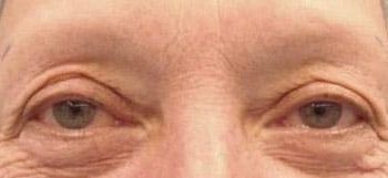 Brow Lift case #10928