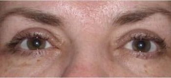 Brow Lift case #10925