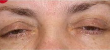 Brow Lift case #10925