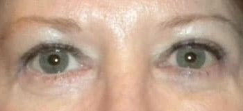 Brow Lift case #10931