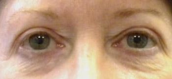 Brow Lift case #10931