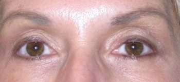 Brow Lift case #10921