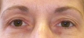 Brow Lift case #10921
