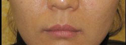 BOTOX® & Dysport case #10643