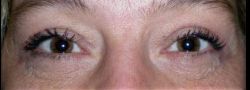 Upper Eyelid Blepharoplasty case #10851