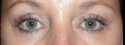 Upper Eyelid Blepharoplasty case #10896