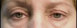 Upper Eyelid Blepharoplasty case #10896