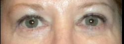 Upper Eyelid Blepharoplasty case #10893