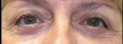 Upper Eyelid Blepharoplasty case #10899