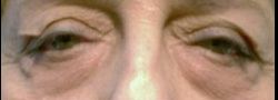Upper Eyelid Blepharoplasty case #10899