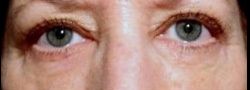 Upper Eyelid Blepharoplasty case #10902