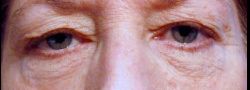 Upper Eyelid Blepharoplasty case #10902