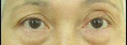 Upper Eyelid Blepharoplasty case #10905