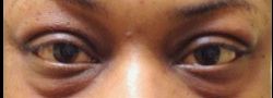 Upper Eyelid Blepharoplasty case #10854