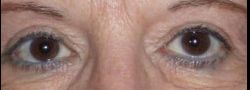 Upper Eyelid Blepharoplasty case #10857