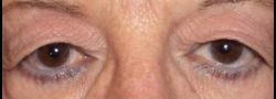 Upper Eyelid Blepharoplasty case #10857