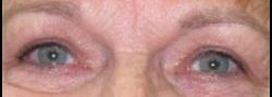 Upper Eyelid Blepharoplasty case #10860