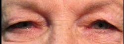 Upper Eyelid Blepharoplasty case #10860