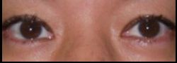 Upper Eyelid Blepharoplasty case #10863
