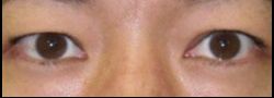Upper Eyelid Blepharoplasty case #10863