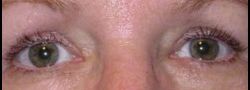 Upper Eyelid Blepharoplasty case #10914