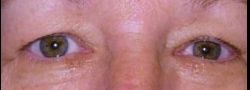 Upper Eyelid Blepharoplasty case #10914