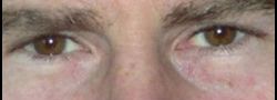 Upper Eyelid Blepharoplasty case #10872