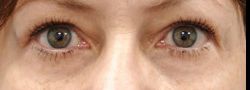 Upper Eyelid Blepharoplasty case #10875