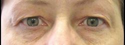Upper Eyelid Blepharoplasty case #10875