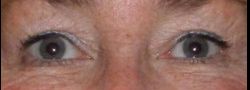 Upper Eyelid Blepharoplasty case #10878