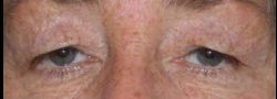Upper Eyelid Blepharoplasty case #10878