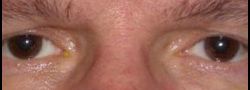 Upper Eyelid Blepharoplasty case #10881