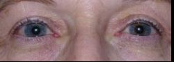 Upper Eyelid Blepharoplasty case #10884