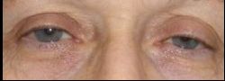 Upper Eyelid Blepharoplasty case #10884