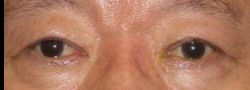 Upper Eyelid Blepharoplasty case #10890
