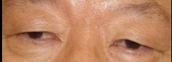 Upper Eyelid Blepharoplasty case #10890