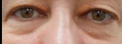 Lower Eyelid Blepharoplasty case #10833