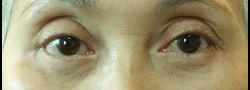 Lower Eyelid Blepharoplasty case #10830