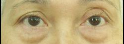 Lower Eyelid Blepharoplasty case #10830