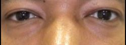 Lower Eyelid Blepharoplasty case #10827