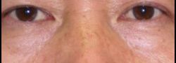 Lower Eyelid Blepharoplasty case #10824