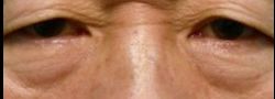 Lower Eyelid Blepharoplasty case #10824