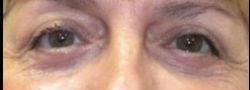 Lower Eyelid Blepharoplasty case #10821