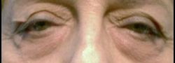 Lower Eyelid Blepharoplasty case #10821