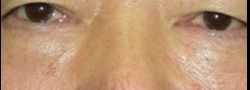 Lower Eyelid Blepharoplasty case #10815